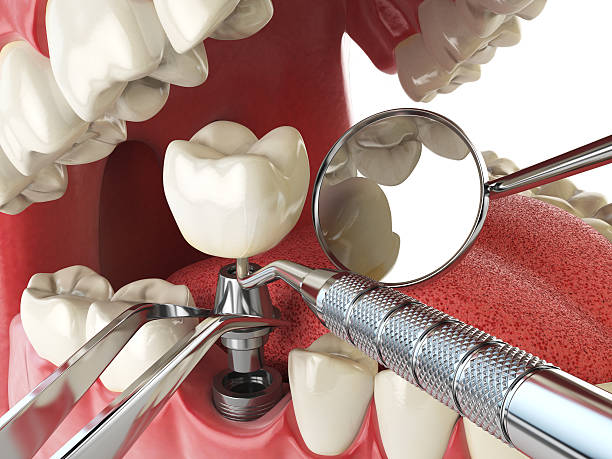 Best Emergency Dentist for Knocked-Out Tooth in Martin, TN